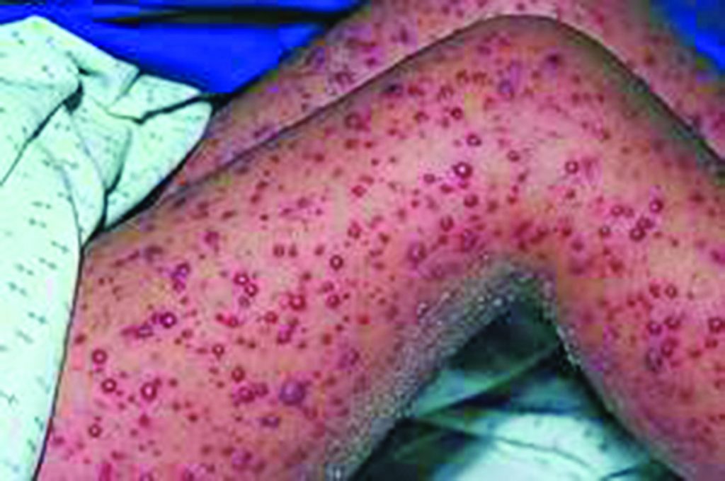 Over 150 affected by chicken pox outbreak in Paramakatoi.