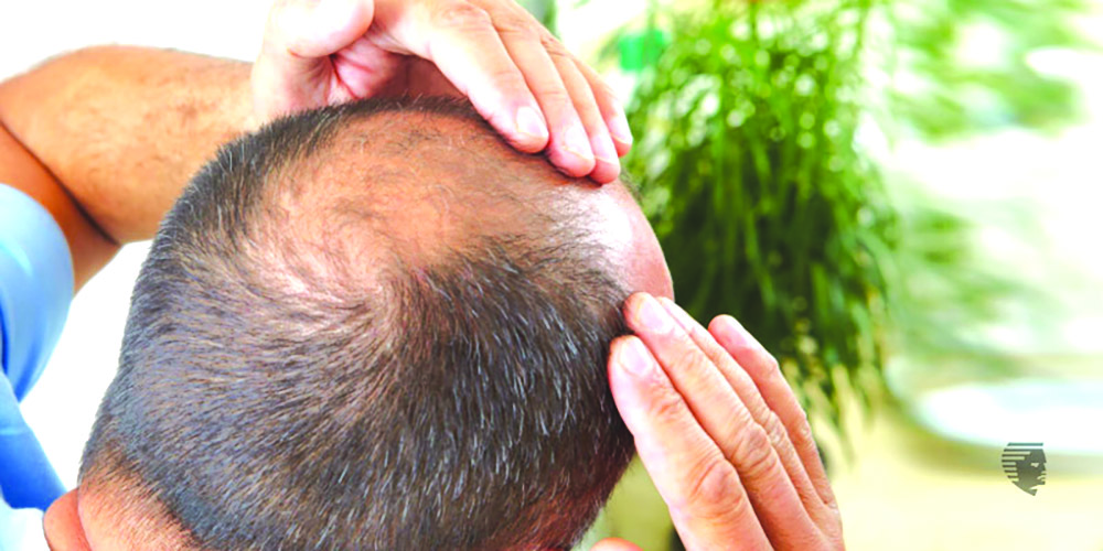 HEALTH TIPS: HAIR LOSS- ALOPECIA - Guyana Times