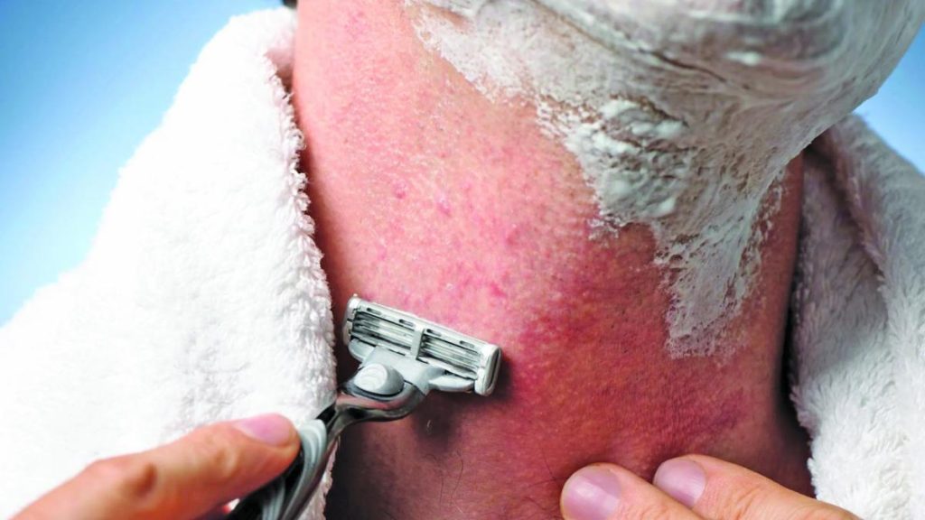TREATMENT AND PREVENTION OF RAZOR BUMPS - Guyana Times